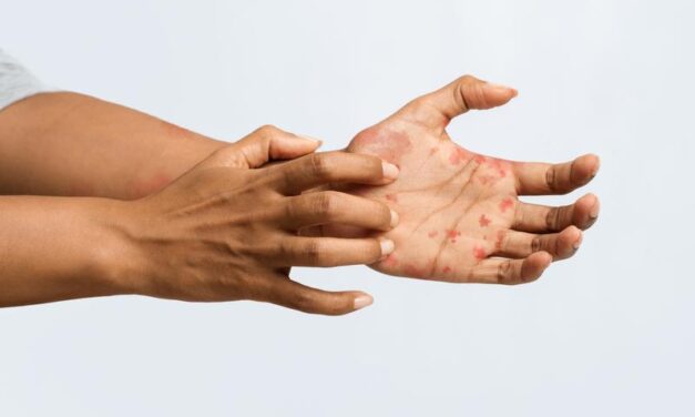 Serious illnesses your skin may be trying to alert you to