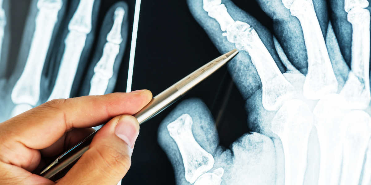 Vitamin D and bone relationship
