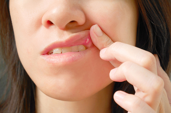 what are mouth ulcers