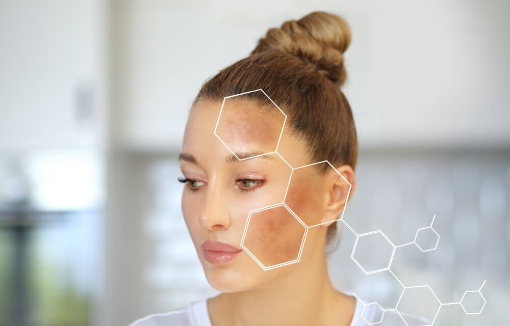 Your guide to treating hyperpigmentation
