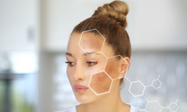 Your guide to treating hyperpigmentation