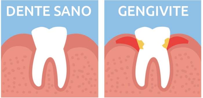 healthy tooth and tooth with gingivitis