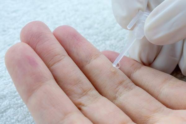 warts how to get rid of them