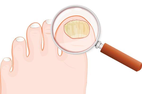 Mycosis-of-the-nails