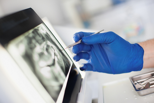 Radius root canal treatment