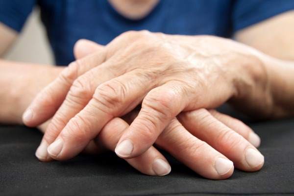 rheumatoid arthritis hands