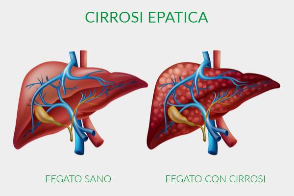 healthy liver and with cirrhosis