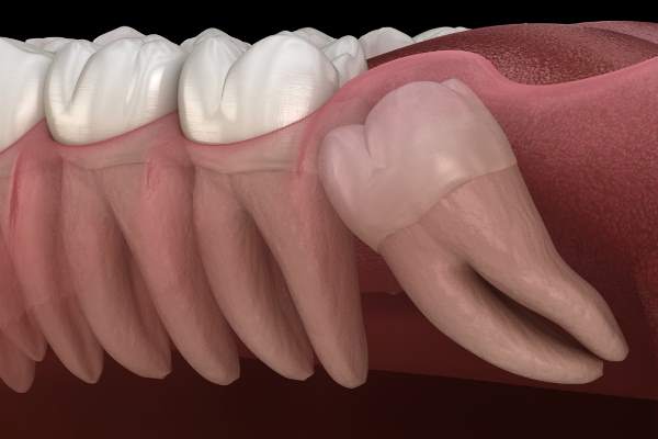 Dental cyst illustration Dental cyst illustration