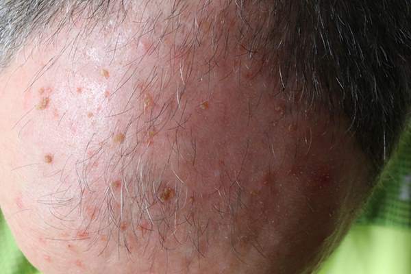Appearance actinic keratoses