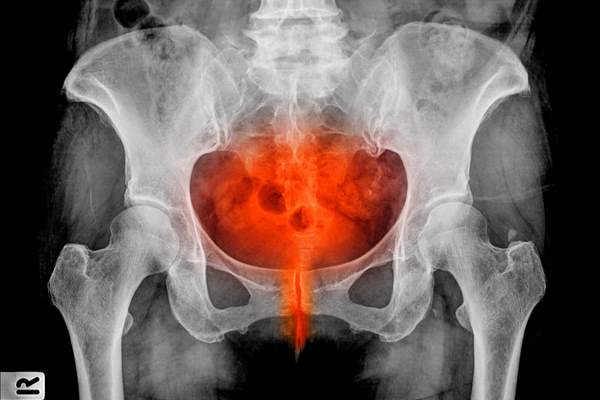 Cystitis