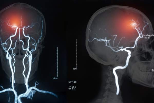 brain stroke diagnosis