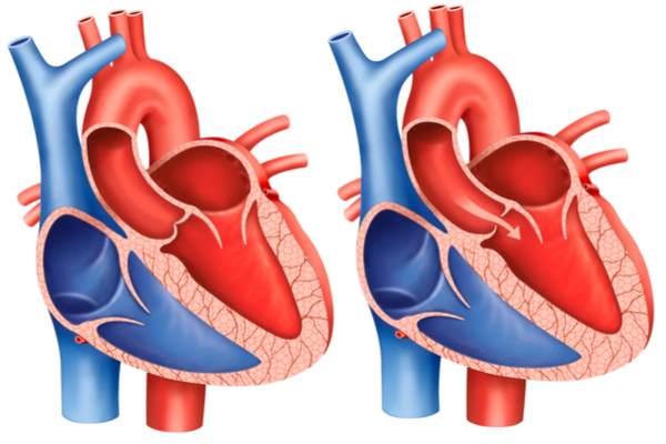 aortic stenosis diagnosis